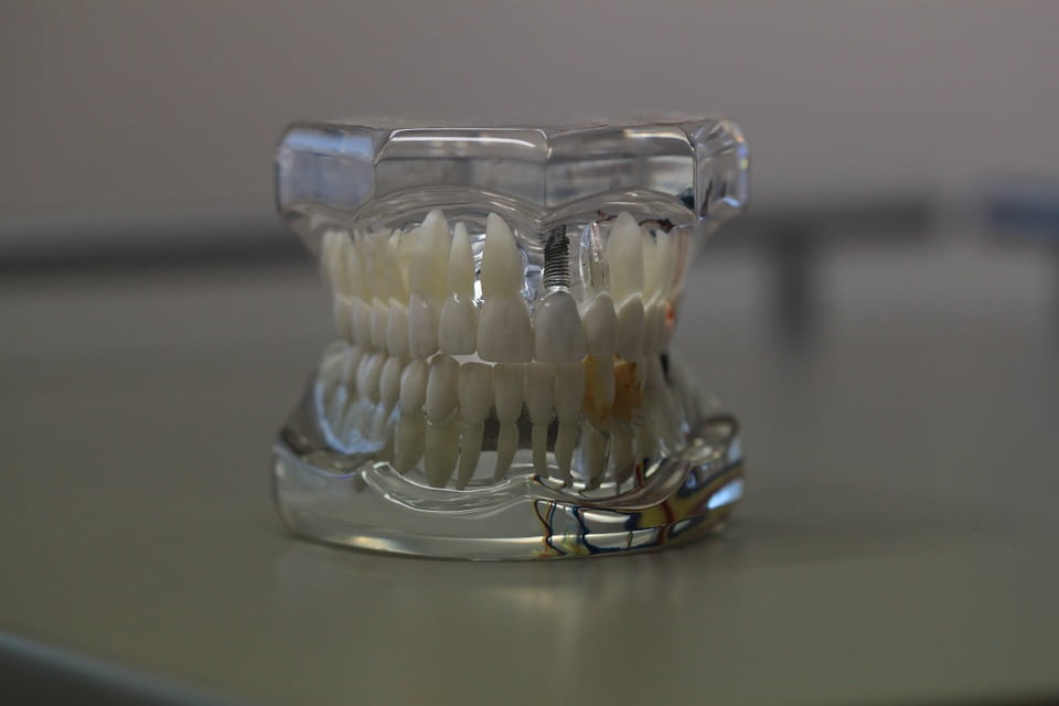 Prothese Dentaire 700 Euros Paris