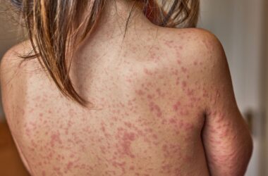 La rougeole dépasse les 1 000 cas aux États-Unis, une première depuis 2019