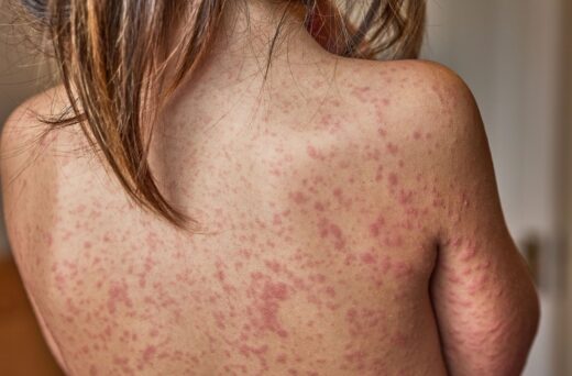 La rougeole dépasse les 1 000 cas aux États-Unis, une première depuis 2019